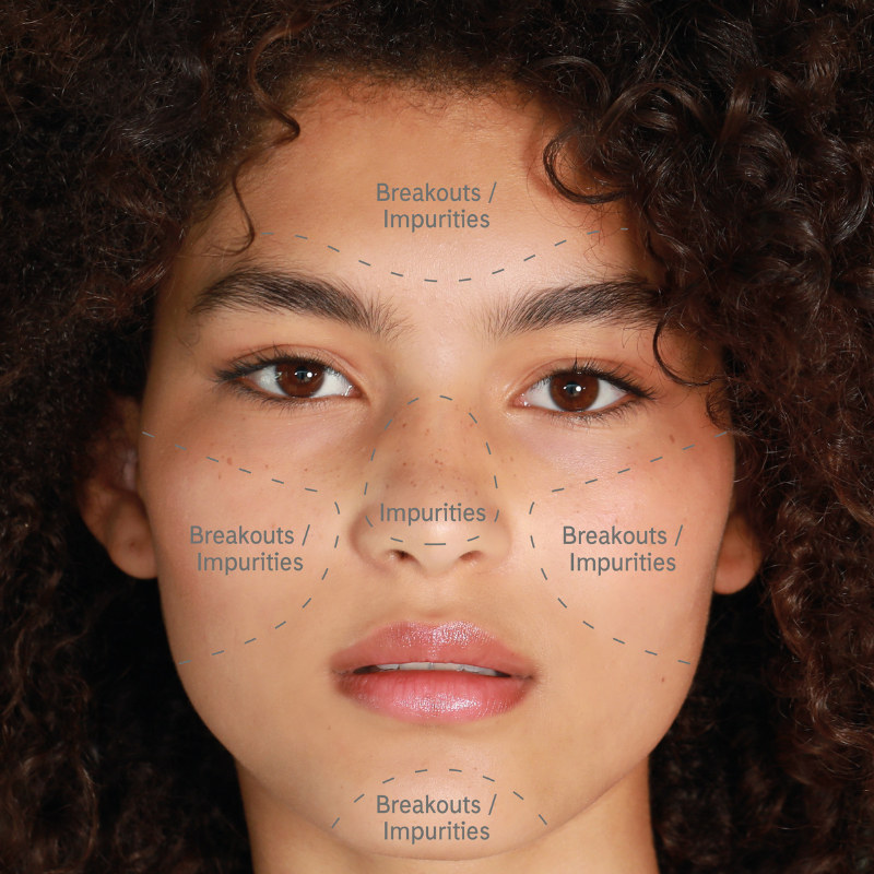 typical symptoms of oily skin include shiny t zone, larger pores, outbreaks and spots.