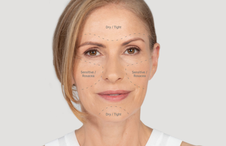 A middle aged blonde woman with her skin concerns written on her face to establish and explain her skin type.